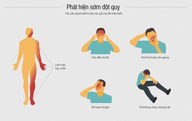 nhận biết các dấu hiệu để phòng ngừa đột quỵ