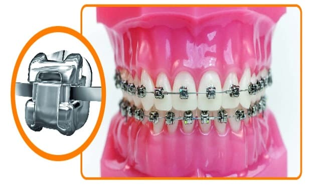 Niềng răng mắc cài kim loại tự động được xem là một cải tiến mới của phương pháp niềng răng cố định