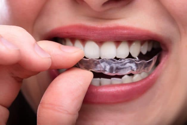 Niềng răng trong suốt Invisalign sử dụng hệ thống khay niềng ôm trọn vào thân răng, có thể dễ dàng tháo lắp