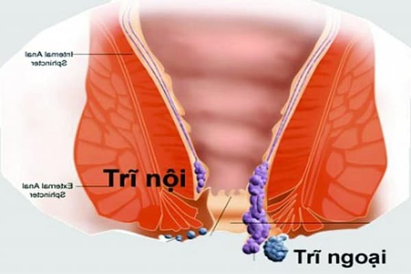 Trĩ nội và trĩ ngoại có thể gây đau hoặc không