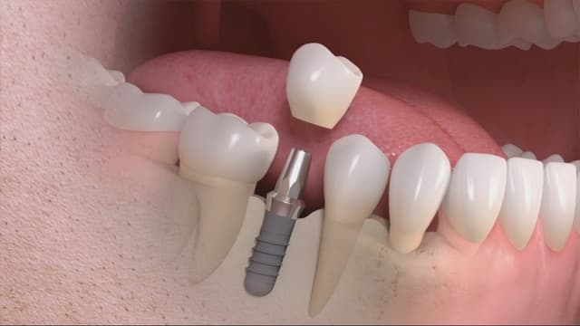 Tìm hiểu về quy trình trồng răng Implant 
