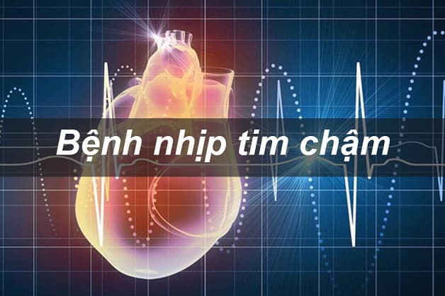rối loạn chậm nhịp tim