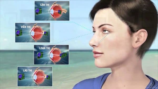 tật khúc xạ bẩm sinh