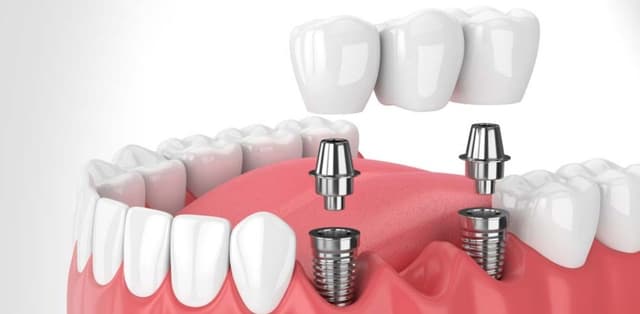 Trồng răng bao nhiêu 1 cái, nên trồng loại nào?