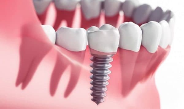 Cấy ghép Implant giúp khôi phục lại răng đã mất cho người bệnh