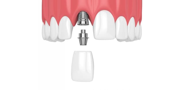 Trồng răng cố định – Phục hình nha khoa hiệu quả dài lâu