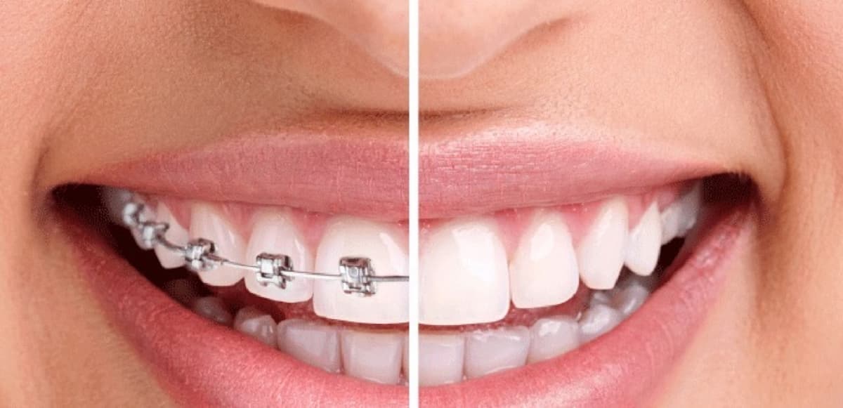 Trước và sau khi niềng răng gương mặt thay đổi thế nào? 