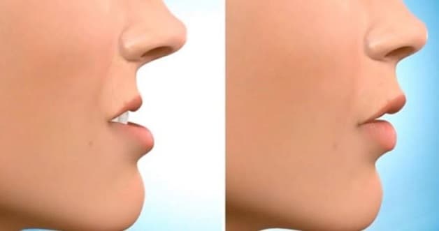 Trước và sau khi niềng răng, khuôn mặt có sự cải thiện rõ rệt, trở nên hài hòa và cân đối hơn