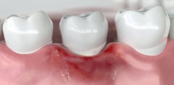 Giai đoạn viêm nướu triển dưỡng có thể gây sưng phồng, tụt lợi