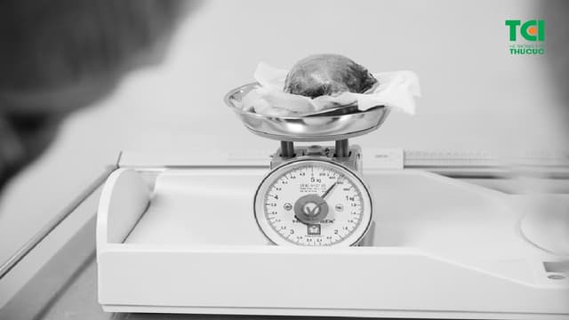 Cắt khối u như thai nhi 5 tháng tuổi cho một phụ nữ ở Hà Nội