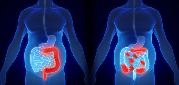 Nguy cơ bệnh ung thư đại tràng