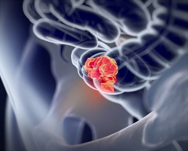 Chẩn đoán bệnh ung thư đại tràng