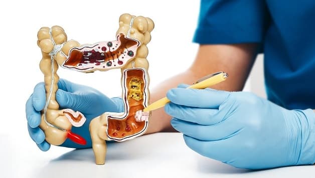 Điều trị bệnh ung thư đại tràng