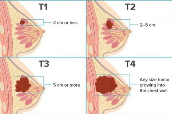 Phương pháp điều trị ung thư vú