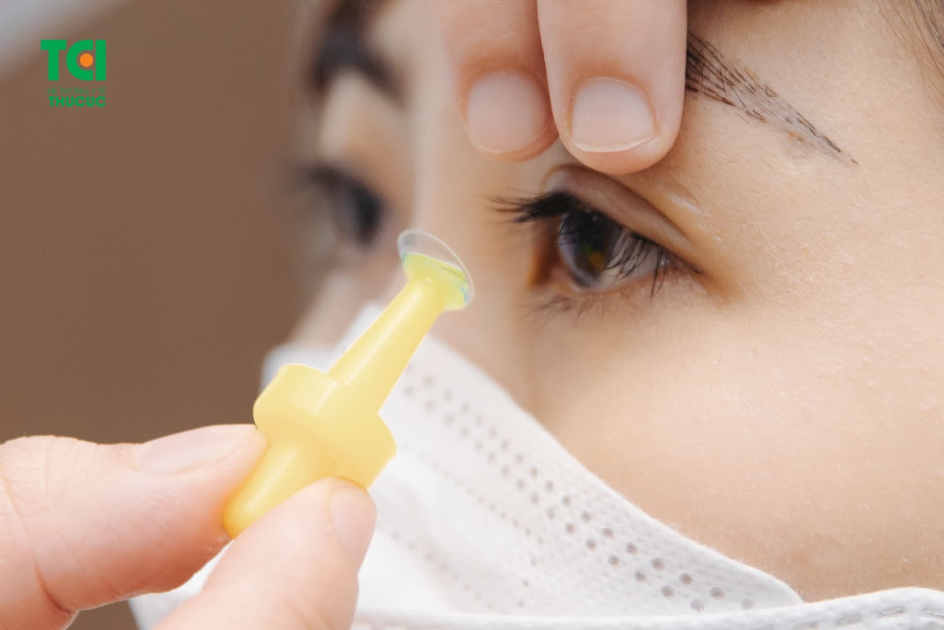 Điều trị cận nhẹ bằng kính áp tròng