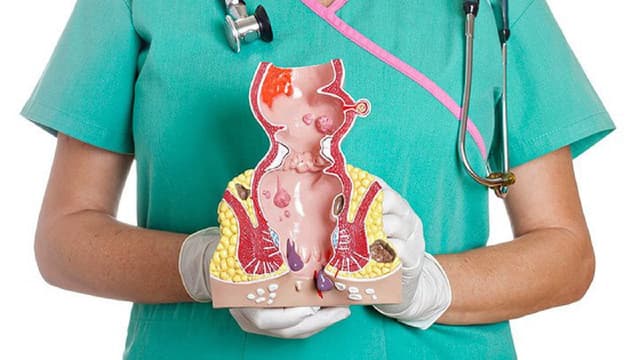 Cắt trĩ laser cần lưu ý điều gì ? – Góc giải đáp