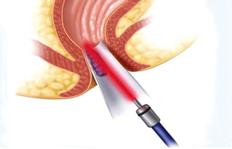 Cắt trĩ bằng laser hiệu quả với các loại trĩ độ 2, độ 3