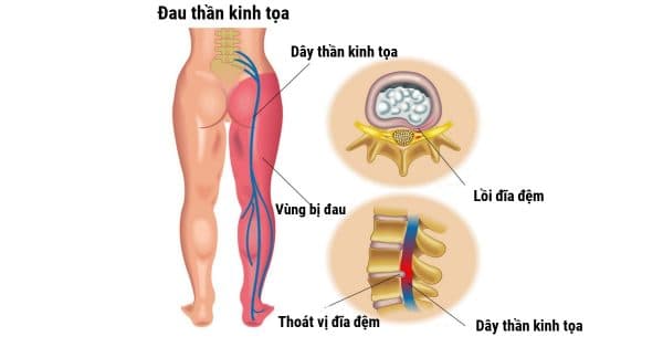 nguyên nhân gây đau thần kinh tọa