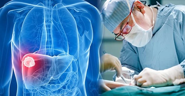 điều trị ung thư gan đa ổ 