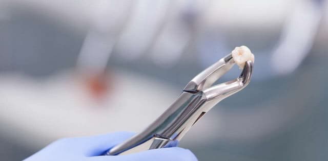 Giá nhổ răng cấm hiện nay bao nhiêu tiền, có cao không?