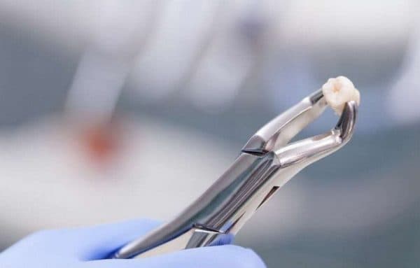 Giá nhổ răng cấm dao động trong khoảng từ vài trăm đến vài triệu đồng, tùy vào tình trạng và số răng cần nhổ