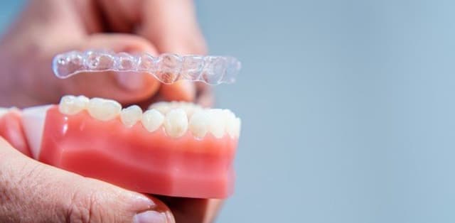 Giá niềng răng không mắc cài hiện nay cao bao nhiêu?