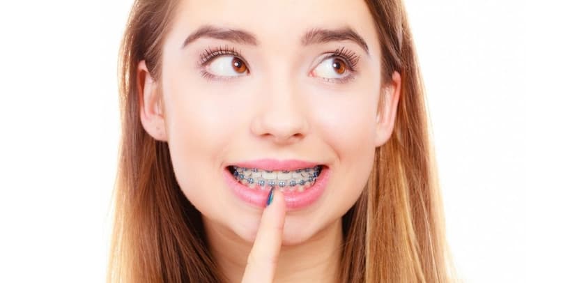 Góc giải đáp: Giá niềng răng thưa mới nhất hiện nay