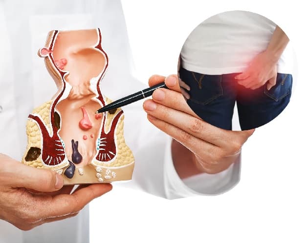 Khám trĩ ở đâu uy tín