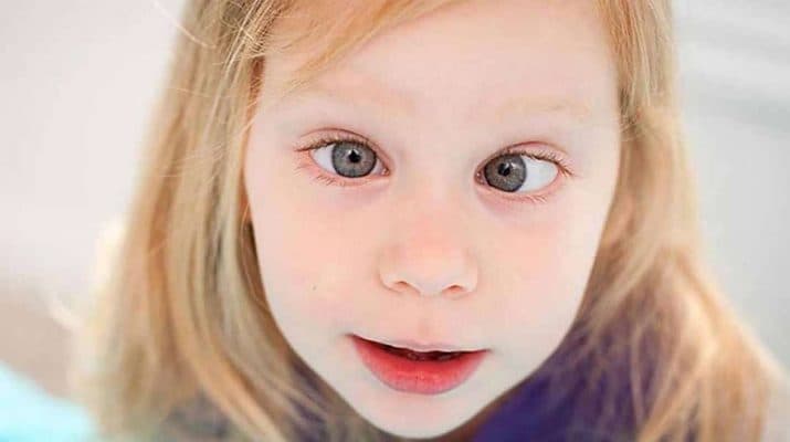 cận thị nặng gây lác ở trẻ