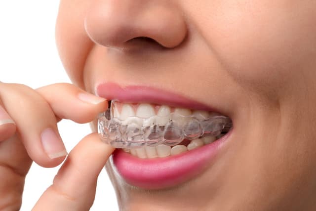 GIẢI ĐÁP: Niềng răng Invisalign giá bao nhiêu?