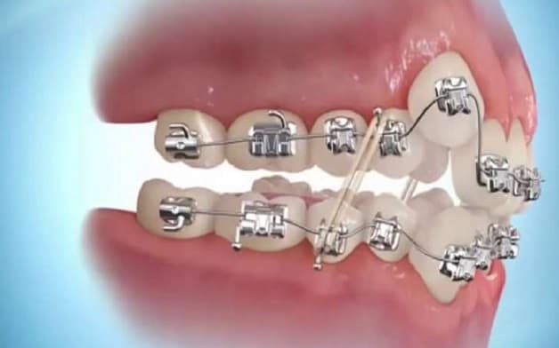 Với thắc mắc niềng răng khểnh bao nhiêu tiền, mỗi phương pháp niềng sẽ có mức giá khác nhau