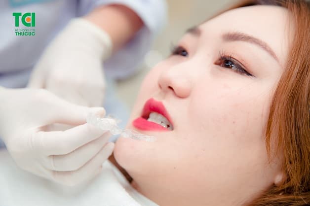 Khách hàng chỉnh nha Invisalign tại Thu Cúc TCI