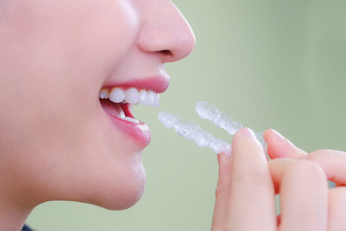 Niềng răng trong suốt giá bao nhiêu?