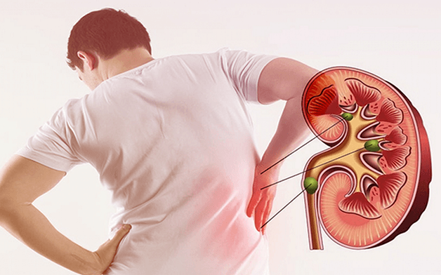 tán sỏi qua da áp dụng cho những ai