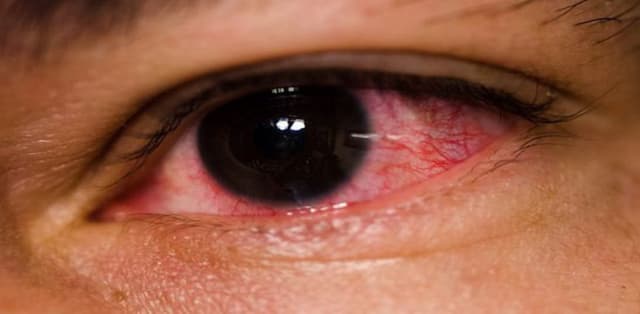 Bệnh thiên đầu thống có chữa được không?