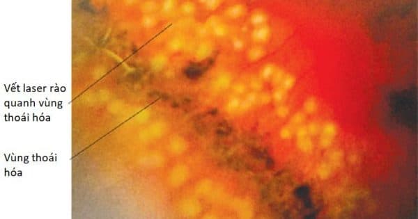 thoái hóa võng mạc cận thị