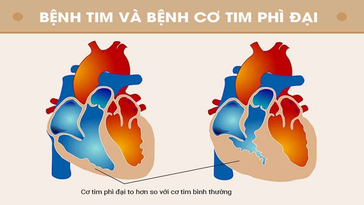 Bệnh cơ tim phì đại: Nguyên nhân, triệu chứng, điều trị