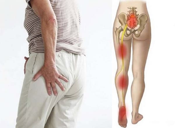 đau thần kinh tọa là đau ở đâu