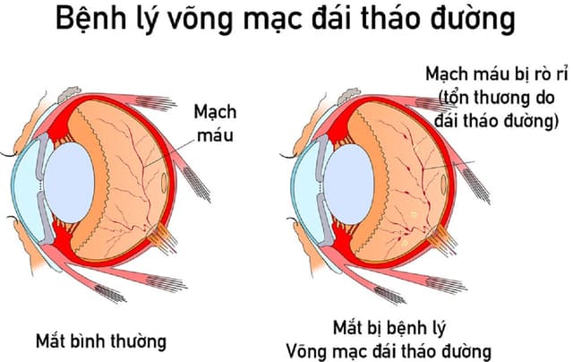 Tổn thương mạch máu ở người mắc bệnh tiểu đường