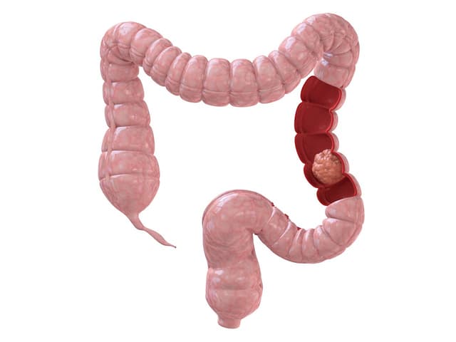Triệu chứng của ung thư đại tràng và giải pháp phòng bệnh