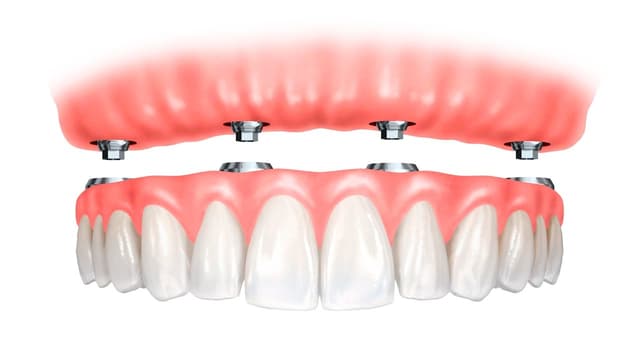 GIẢI ĐÁP: Trồng răng hàm giá bao nhiêu