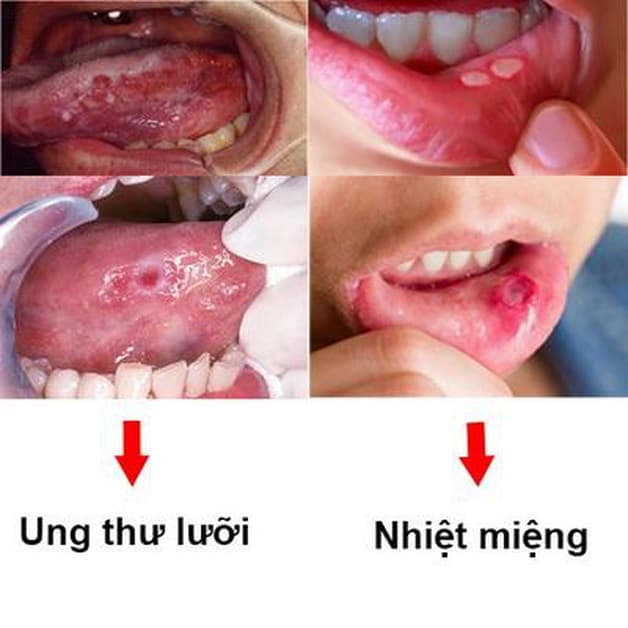 ung thư khoang miệng có chữa được không