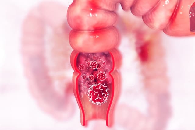 Điều trị ung thư trực tràng và cách phòng bệnh hiệu quả