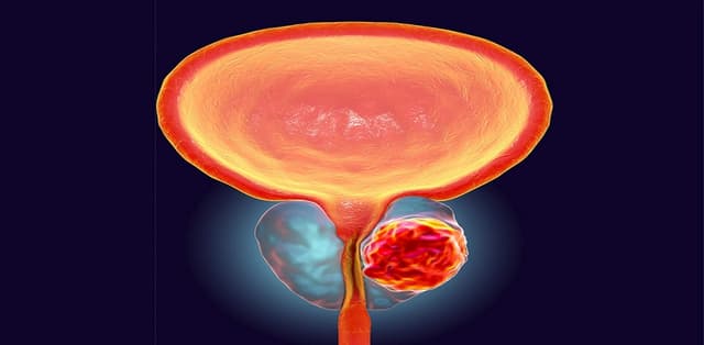 Phương pháp điều trị bệnh ung thư tuyến tiền liệt