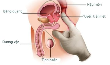 Điều trị ung thư tuyến tiền liệt và những điều cần biết