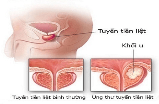 Ung thư tuyến tiền liêt 