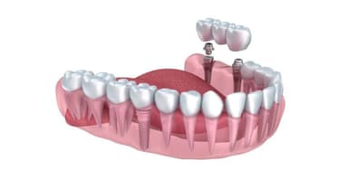 Giá trồng răng Implant Hàn Quốc có cao không?