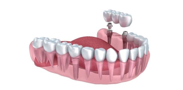 Giá trồng răng Implant Hàn Quốc có cao không?