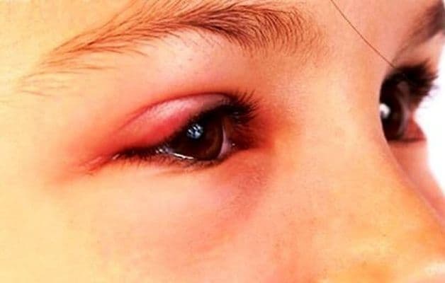 Làm gì khi bị lẹo ở mắt.