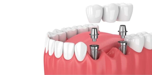 Giải đáp nha khoa: Trồng răng hết bao nhiêu tiền?